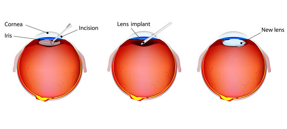 Extracapsular Cataract Extraction