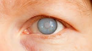 What is  glaucoma?