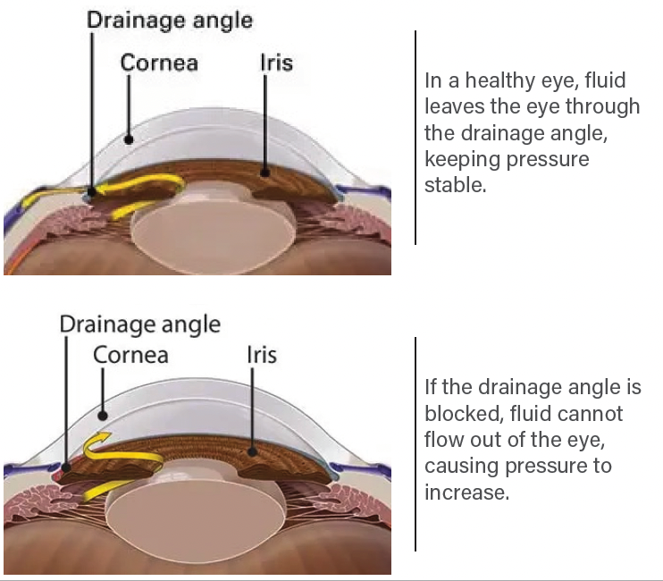 What causes  glaucoma