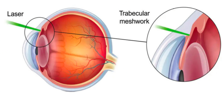 Selective laser trabeculoplasty